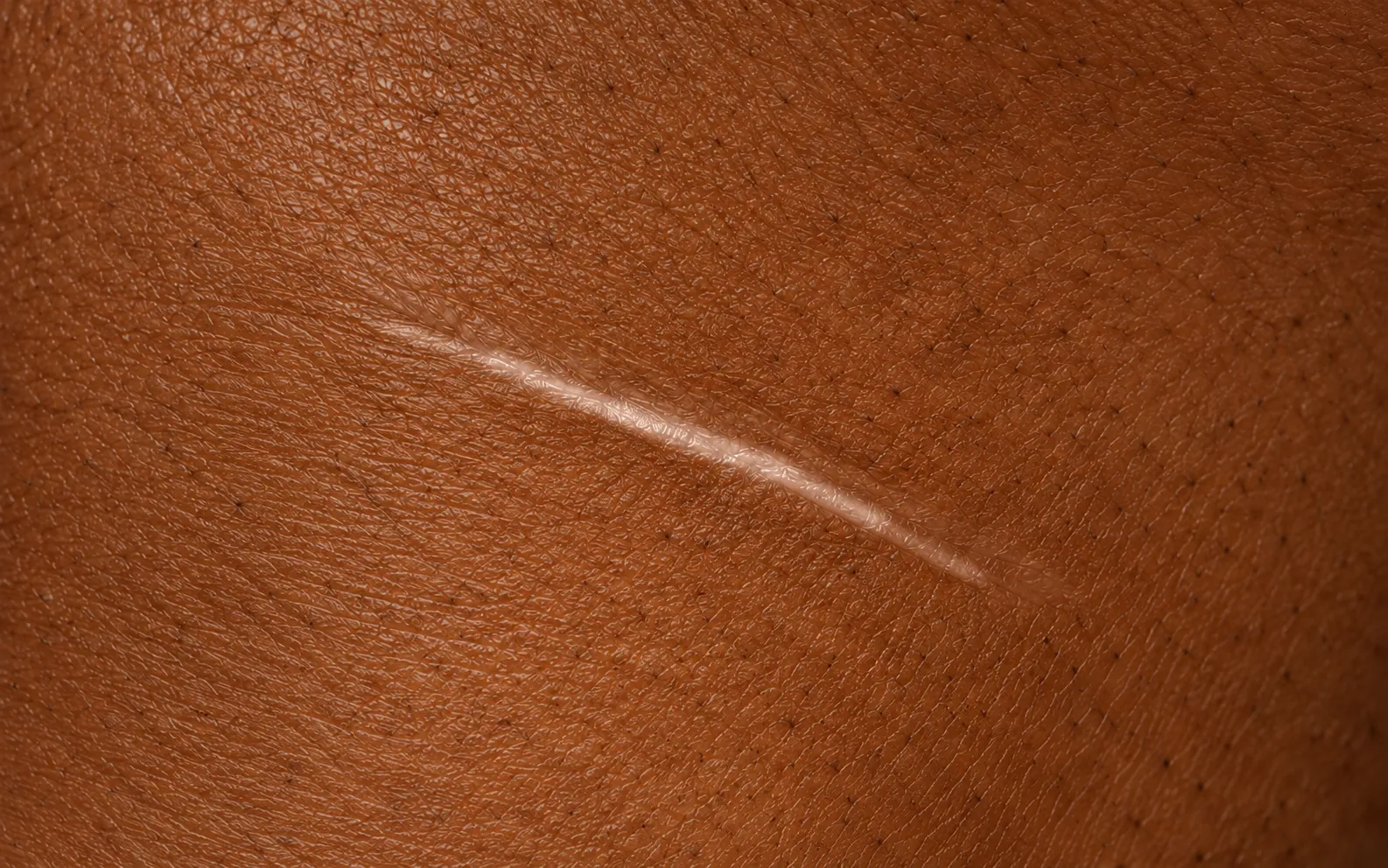 Scar Camouflage, before
