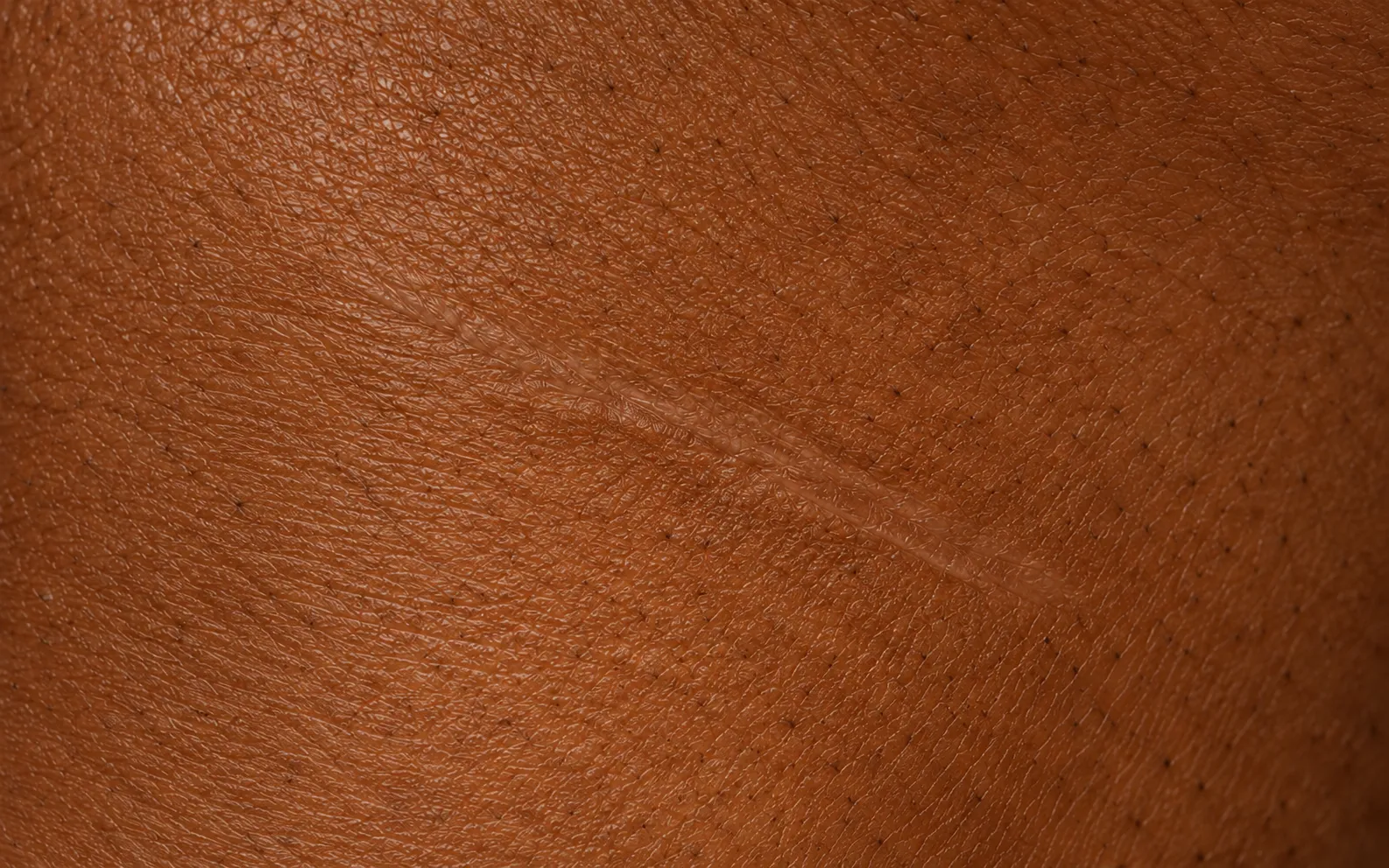 Scar Camouflage, healed